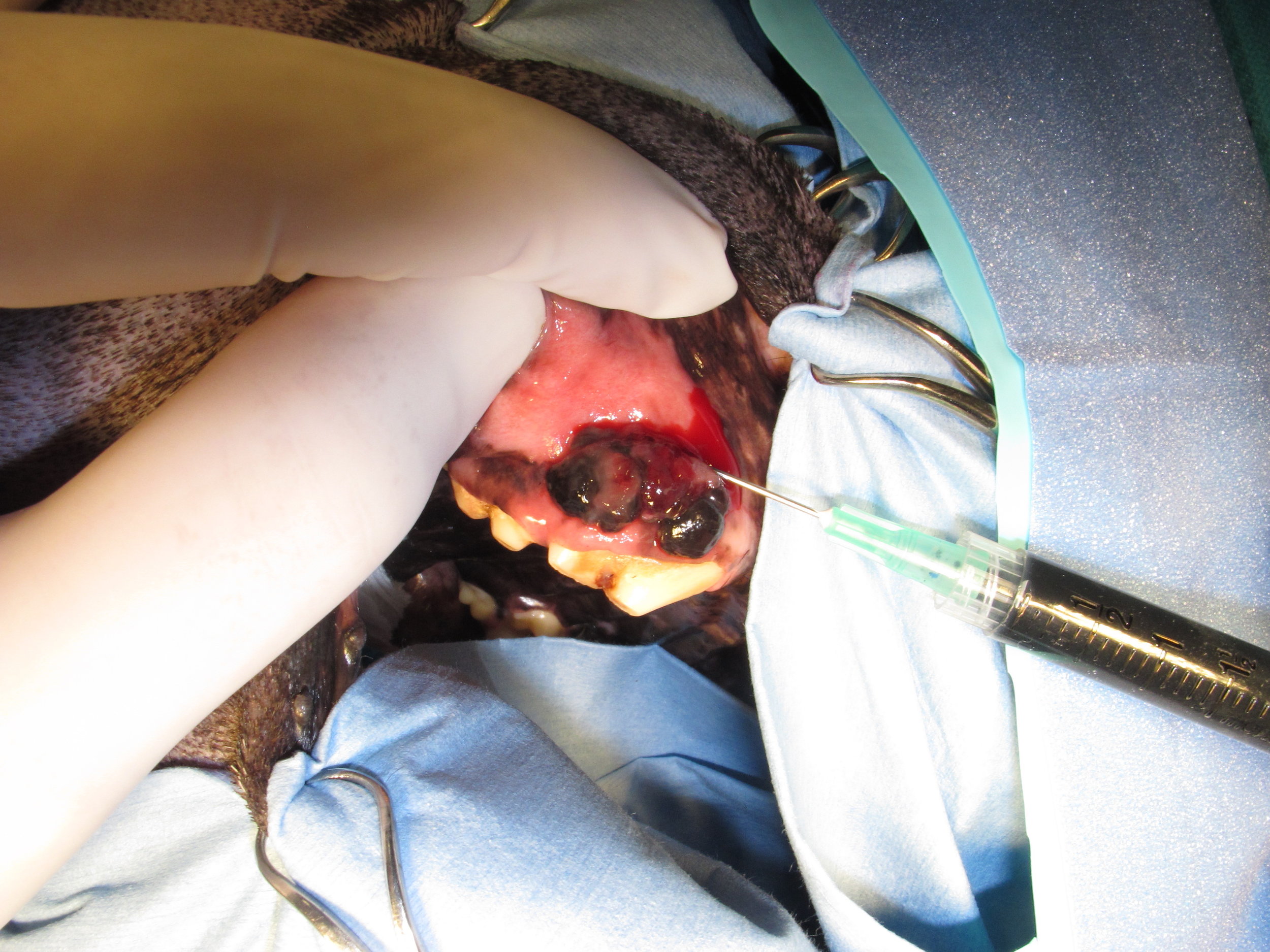 Intraoperative four-quadrant peritumoral injection of methylene blue to aide in identification of the sentinel lymph node during surgery.