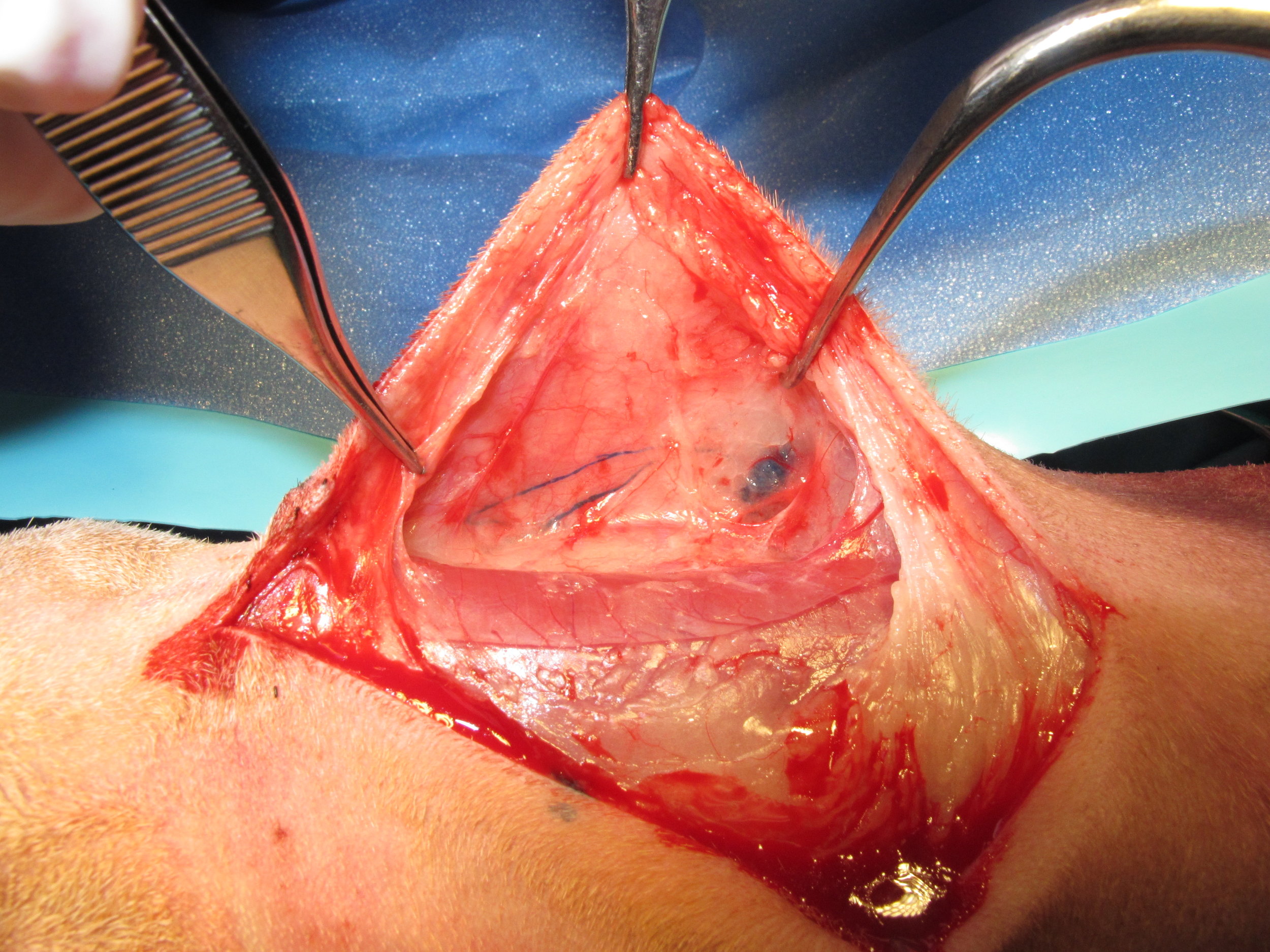 The methylene blue courses through the lymphatics to the sentinel lymph node and both are easily visible intraoperatively because of their blue discolouration.