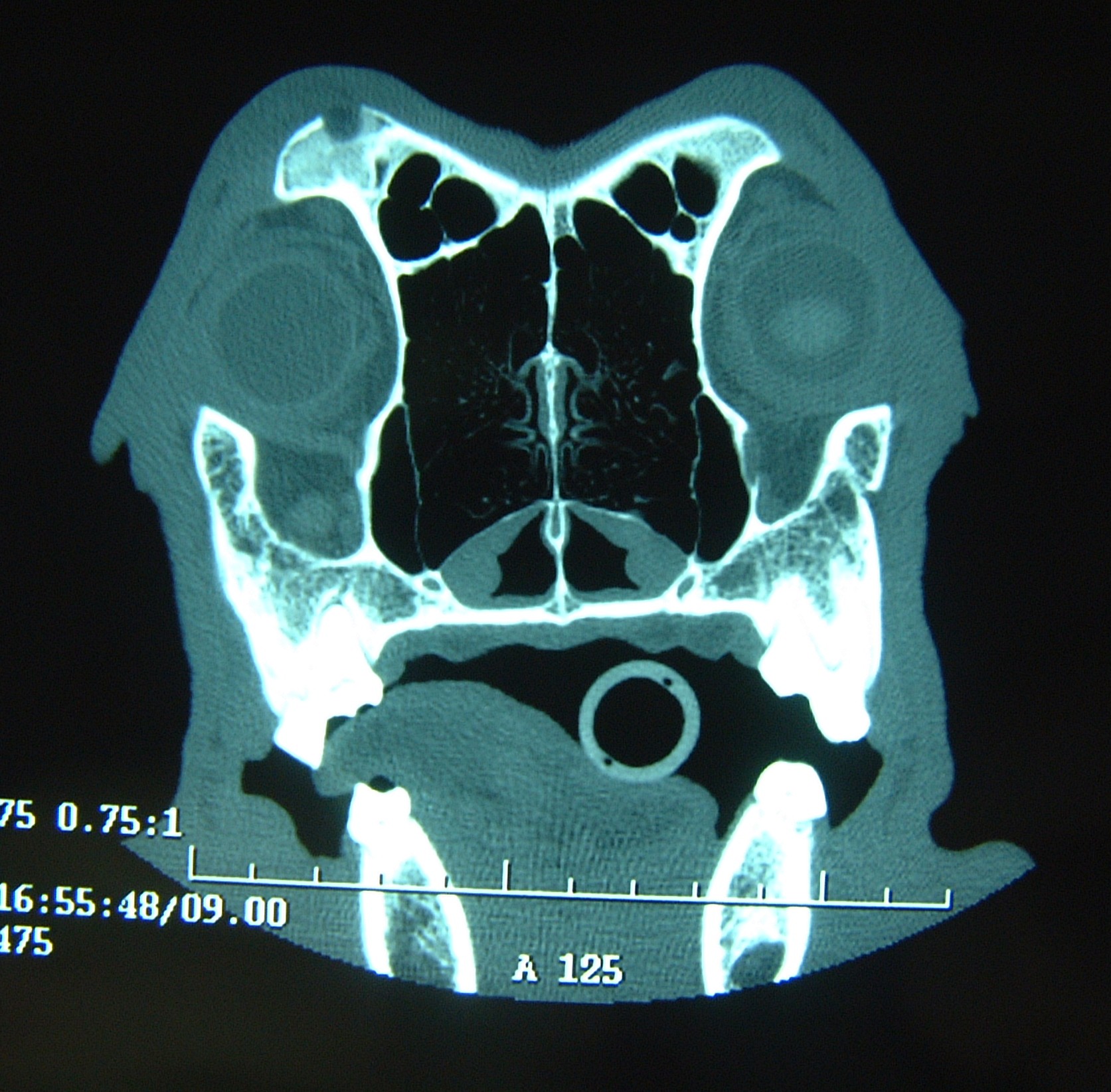 CT Scan - Supraorbital Metastasis (OSA)