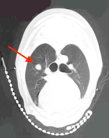CT Scan - Lung Metastasis (OSA)