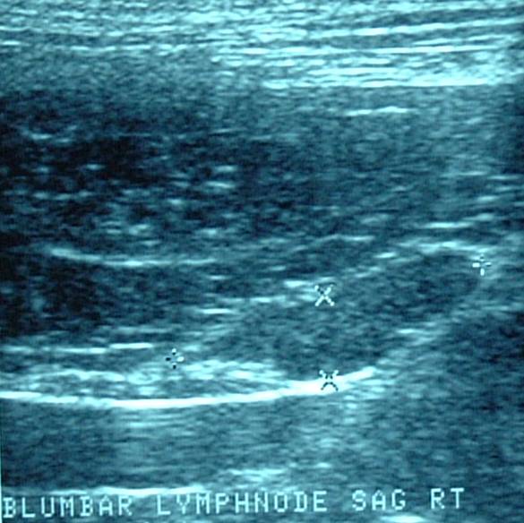 Ultrasound - Sublumbar Lymph Node Metastasis (AGASAC)