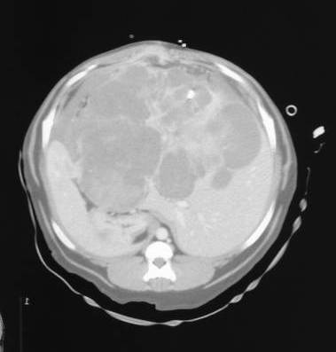 A contrast-enhanced CT scan of a massive HCC. This appeared unresectable on CT scan, but was resected following evaluation during an exploratory celiotomy.