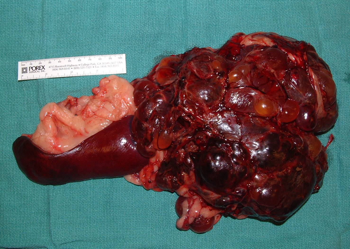 Abdominal Tumors Spleen — DR. JULIUS LIPTAK
