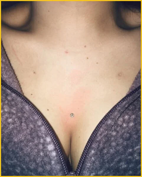 Dermal