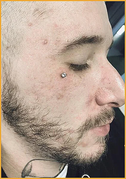 Dermal
