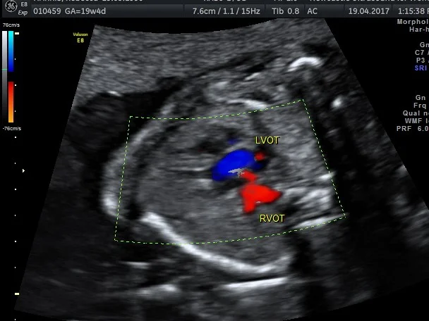 Cardiac outflow tracts