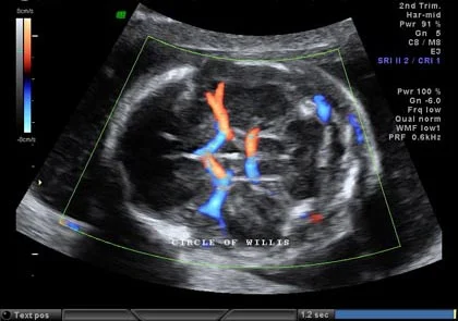 Circle of Willis