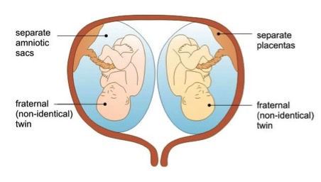 DCDA twins