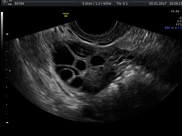 Polycystic ovarian 