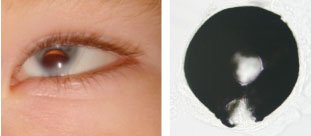 Figure 1 Examples of human and fish eyes with compromised Tfap2 function showing iris and retinal coloboma respectively.