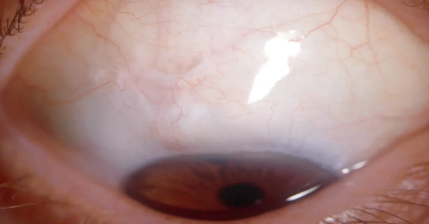 Une-bulle-de-filtration chirurgie glaucome.jpg