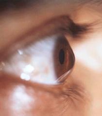 Le kératocône, une maladie chronique.