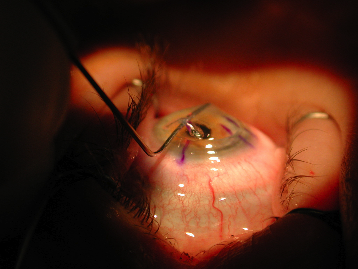 Chirurgie laser myopie. Dr. Levai Lehar