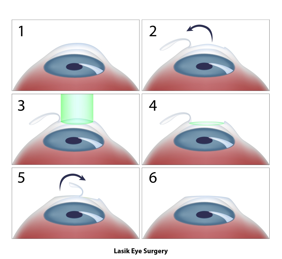 Chirurgie réfractive et Hypermétropie
