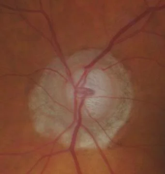 Quel est le risque de développer un glaucome à pression normale sur un oeil quand l'autre est atteint?