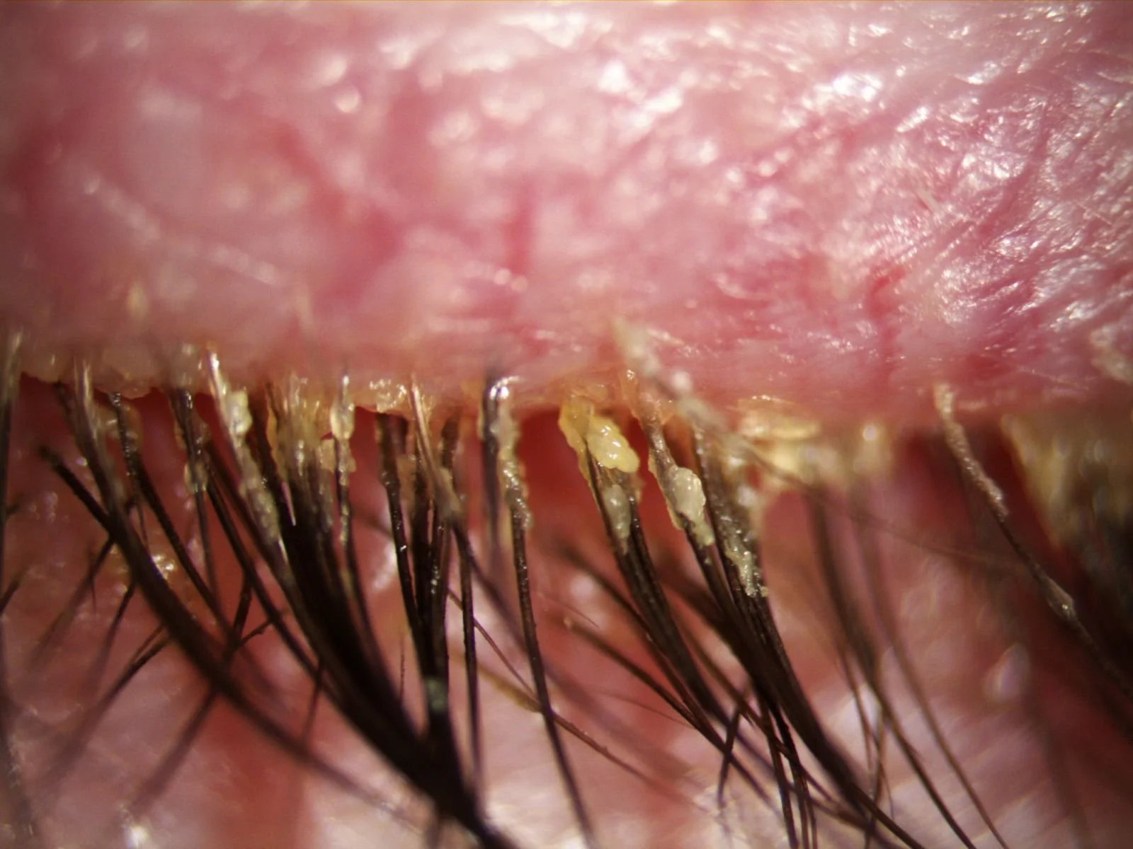 Blépharite et demodex