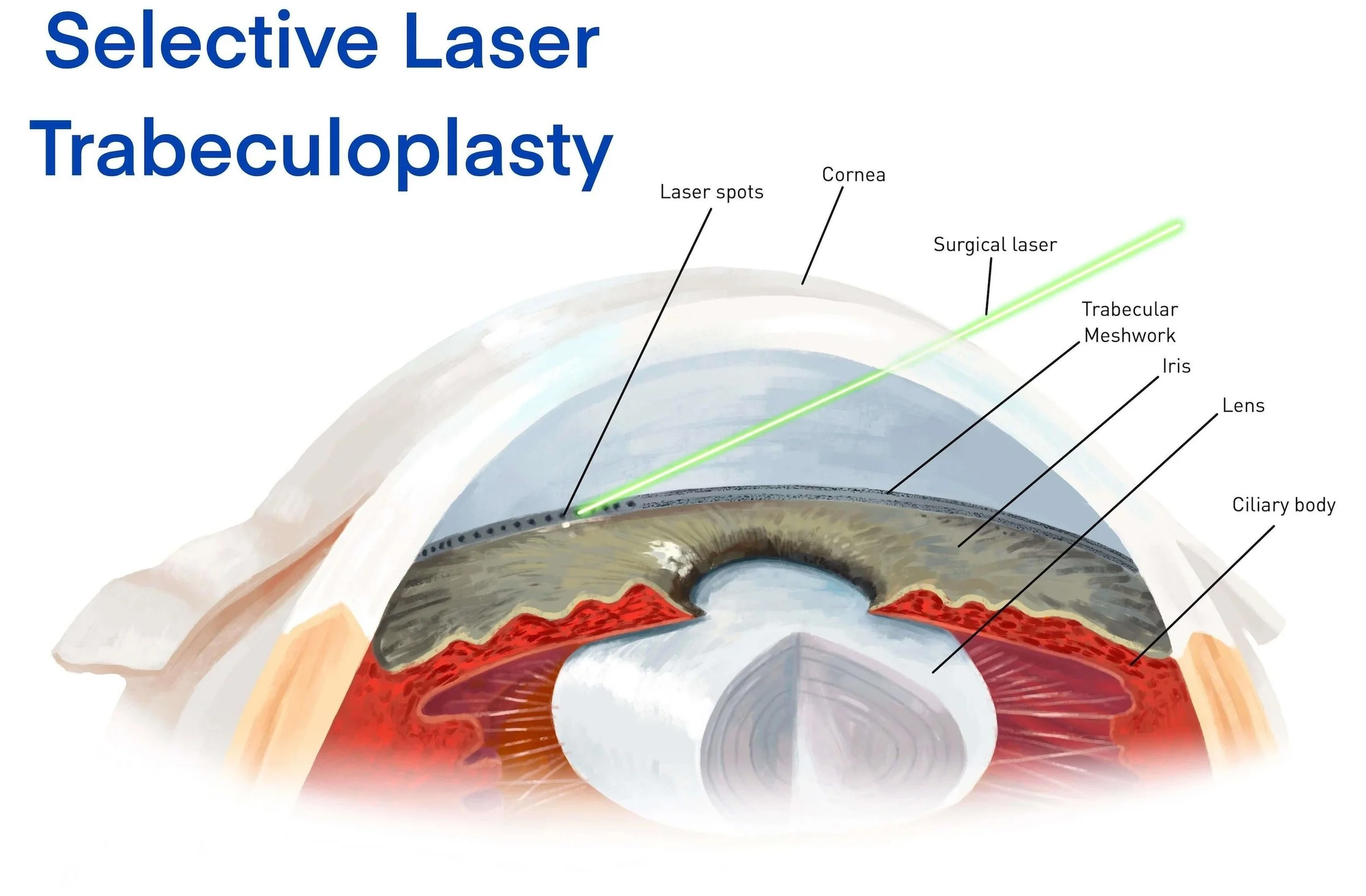 Une nouvelle étude confirme l’efficacité du laser SLT dans la prise en charge du glaucome