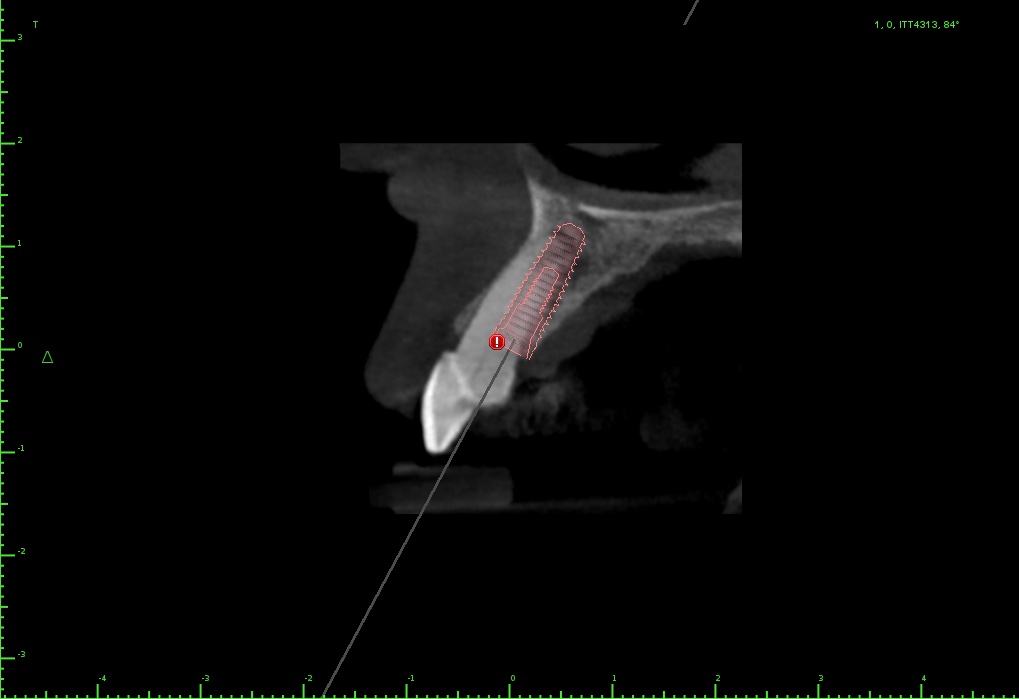 cbctside Implant View.jpg