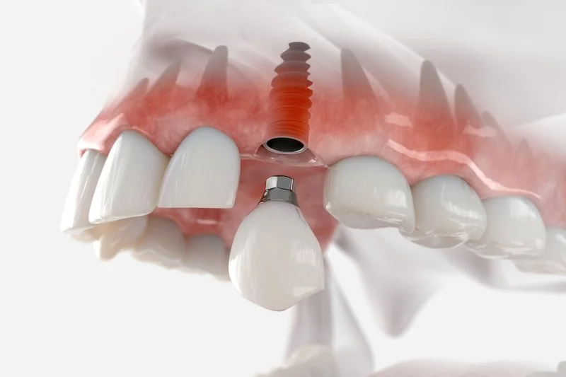 Everything You Should Know About Dental Implants