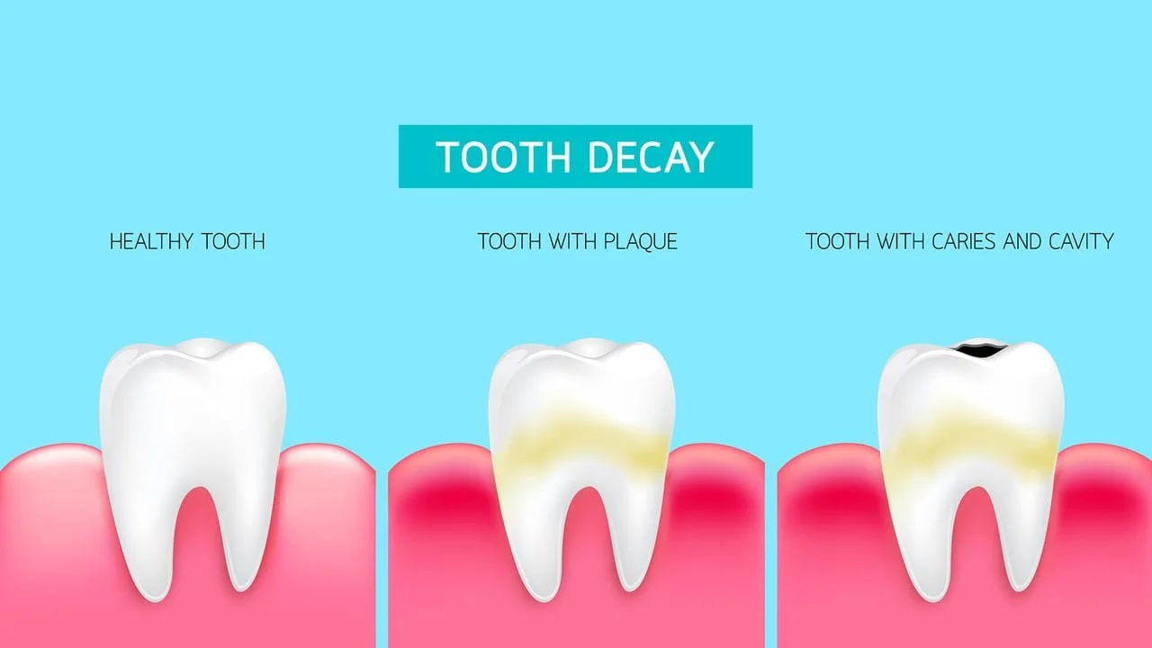 What Causes Tooth Decay?