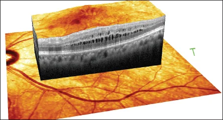 OCT retinal imaging