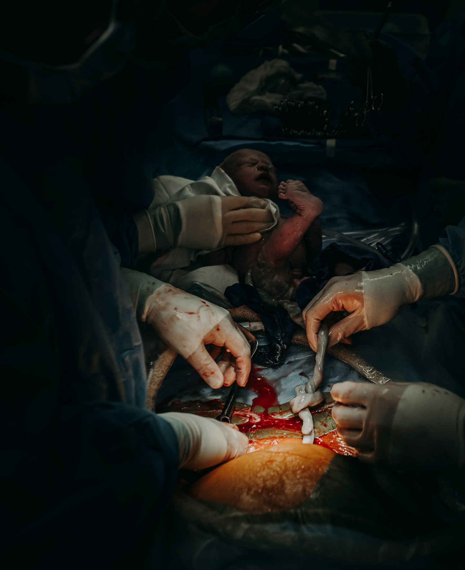 Hawaii-Birth-Photographer-Twins-Cesarean-11.jpg