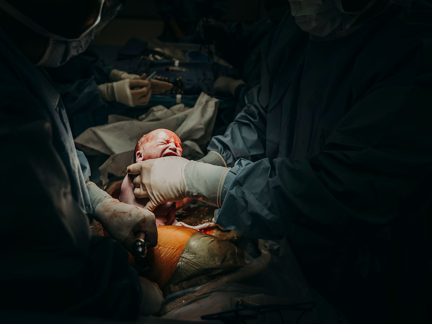 Hawaii-Birth-Photographer-Twins-Cesarean-12.jpg