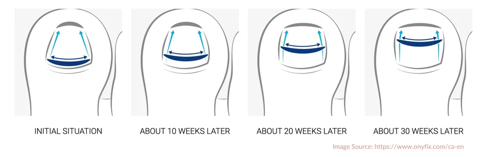 The Onyfix Nail Correction System