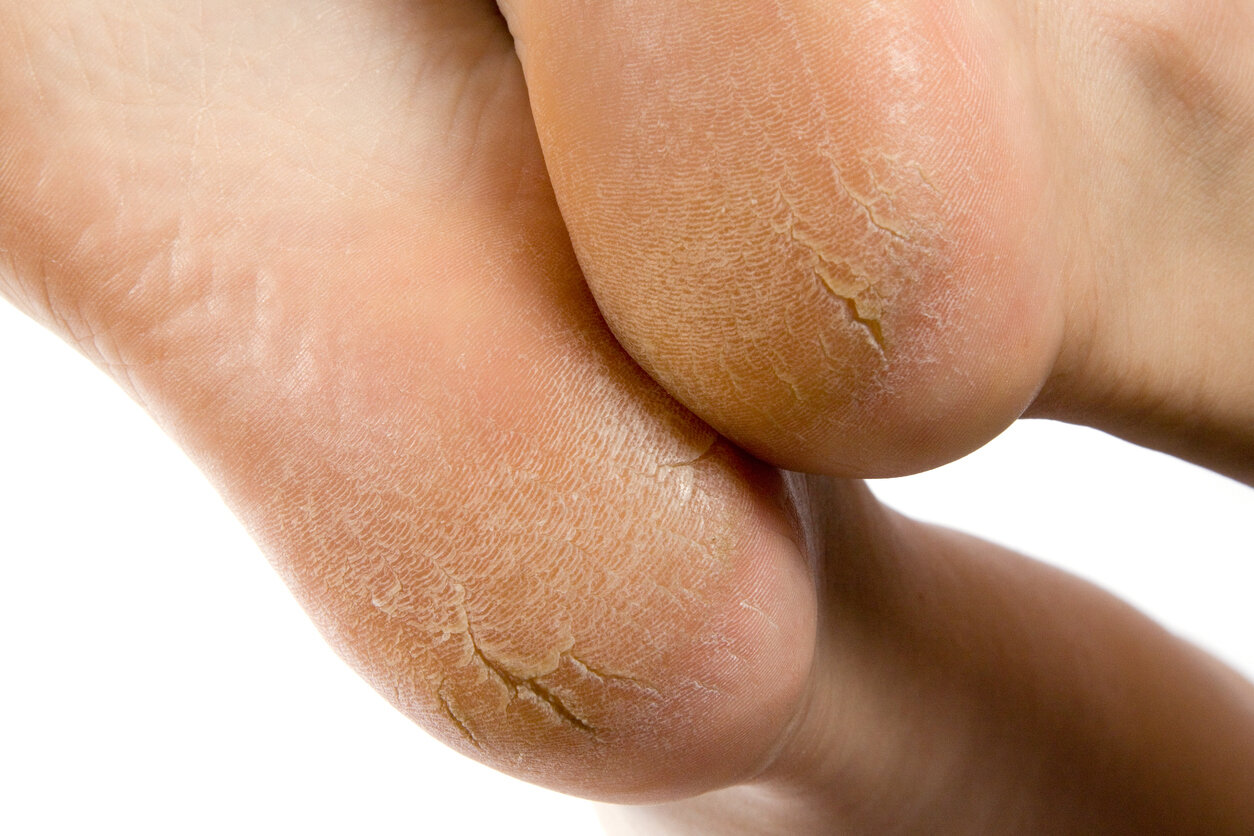 Talwar Skin Centre - Cracked heels....fissure feet.... Get back beautiful  feet with treatment .... | Facebook