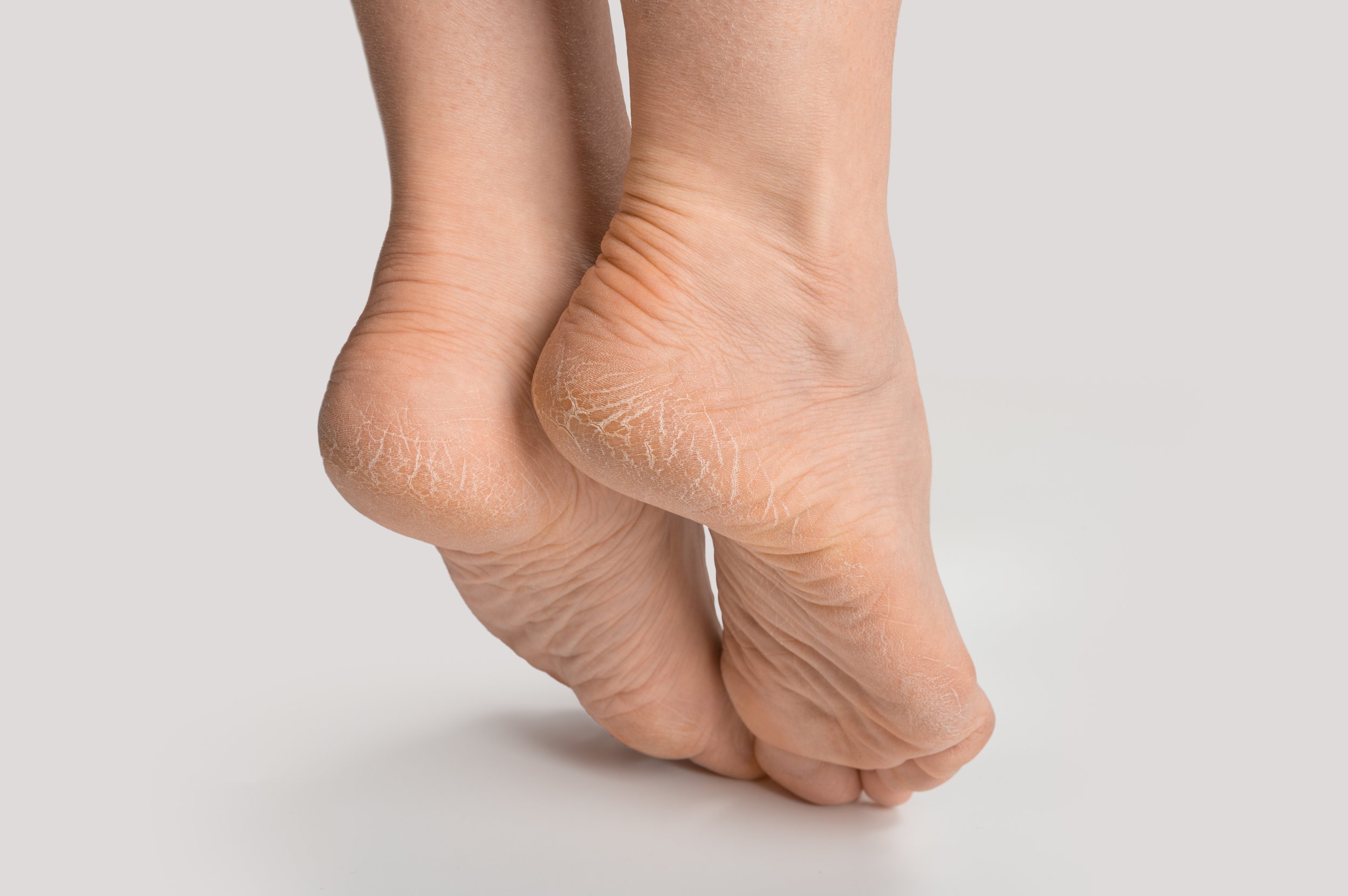 What Really Causes Cracked Heels and How to Heal Them (Part I) - Century  Medical & Dental Center