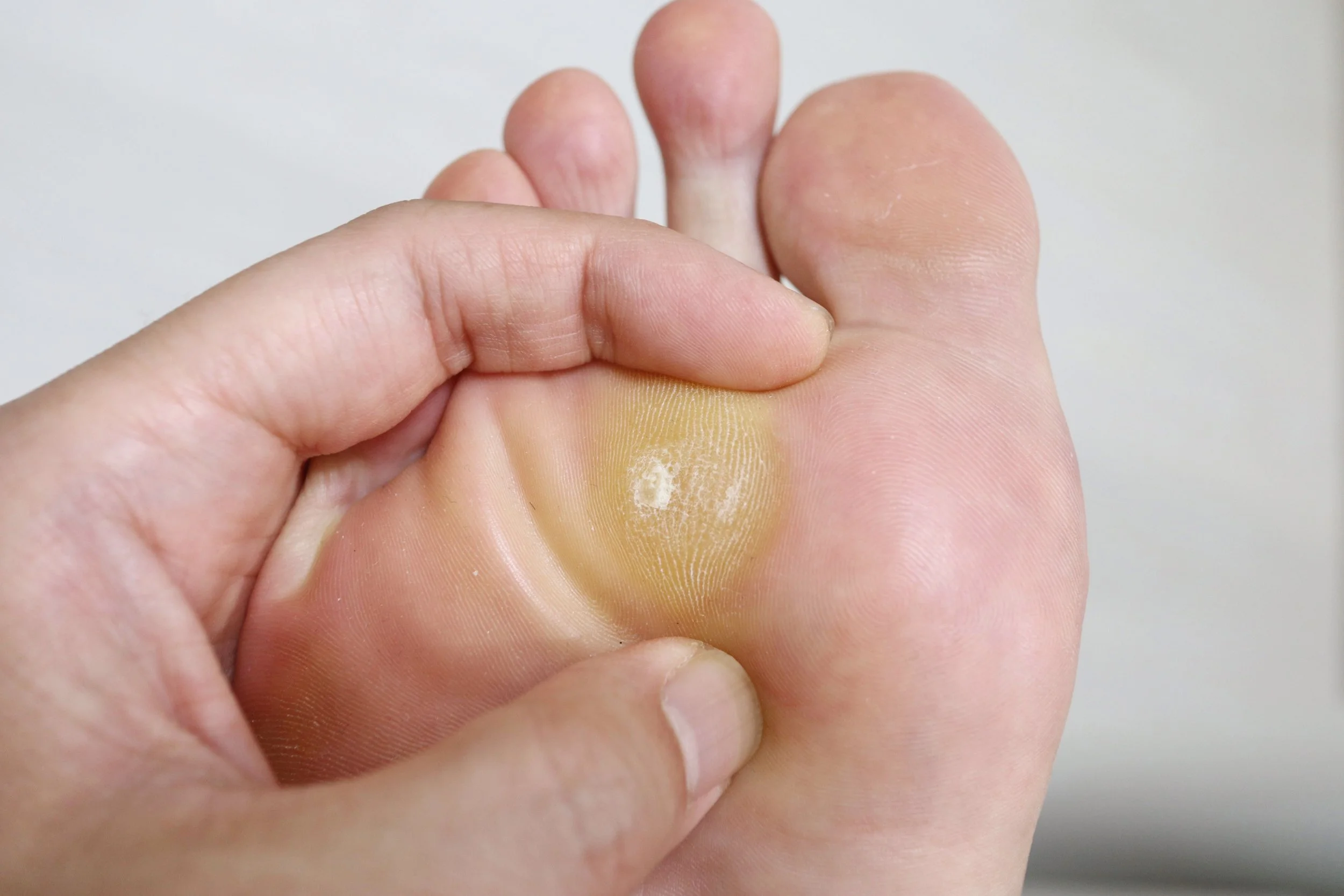 Understanding Corns and Calluses
