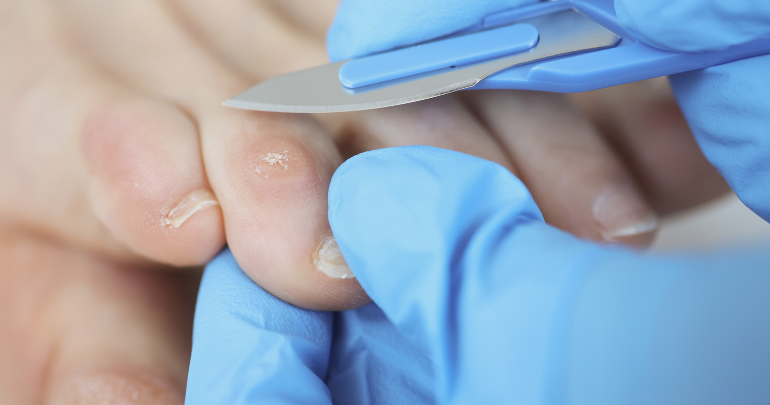 Understanding Corns and Calluses — Blackwood Podiatry Your local