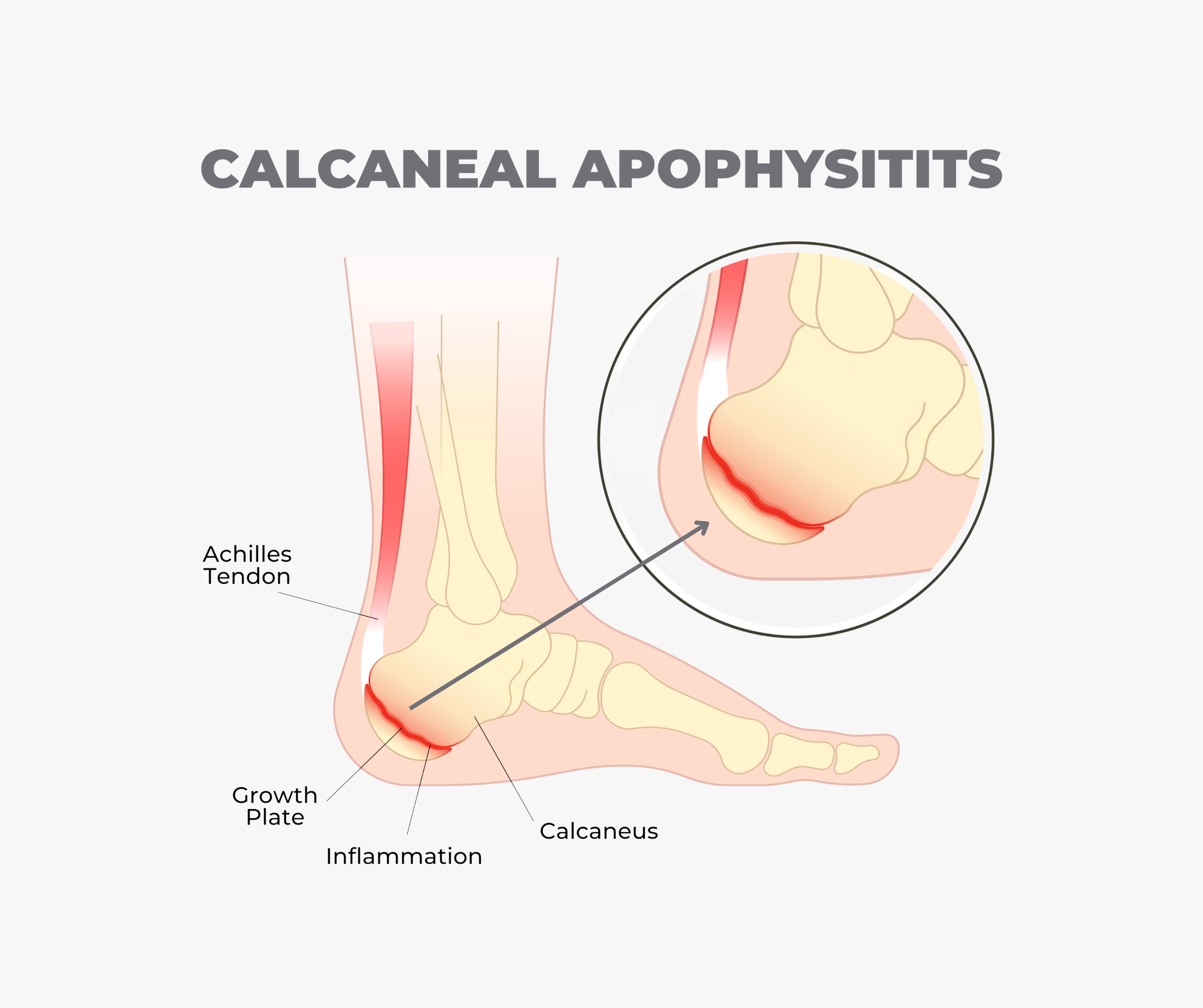 The Importance of Calf Loading: Achilles Tendinopathy — The Run Rx