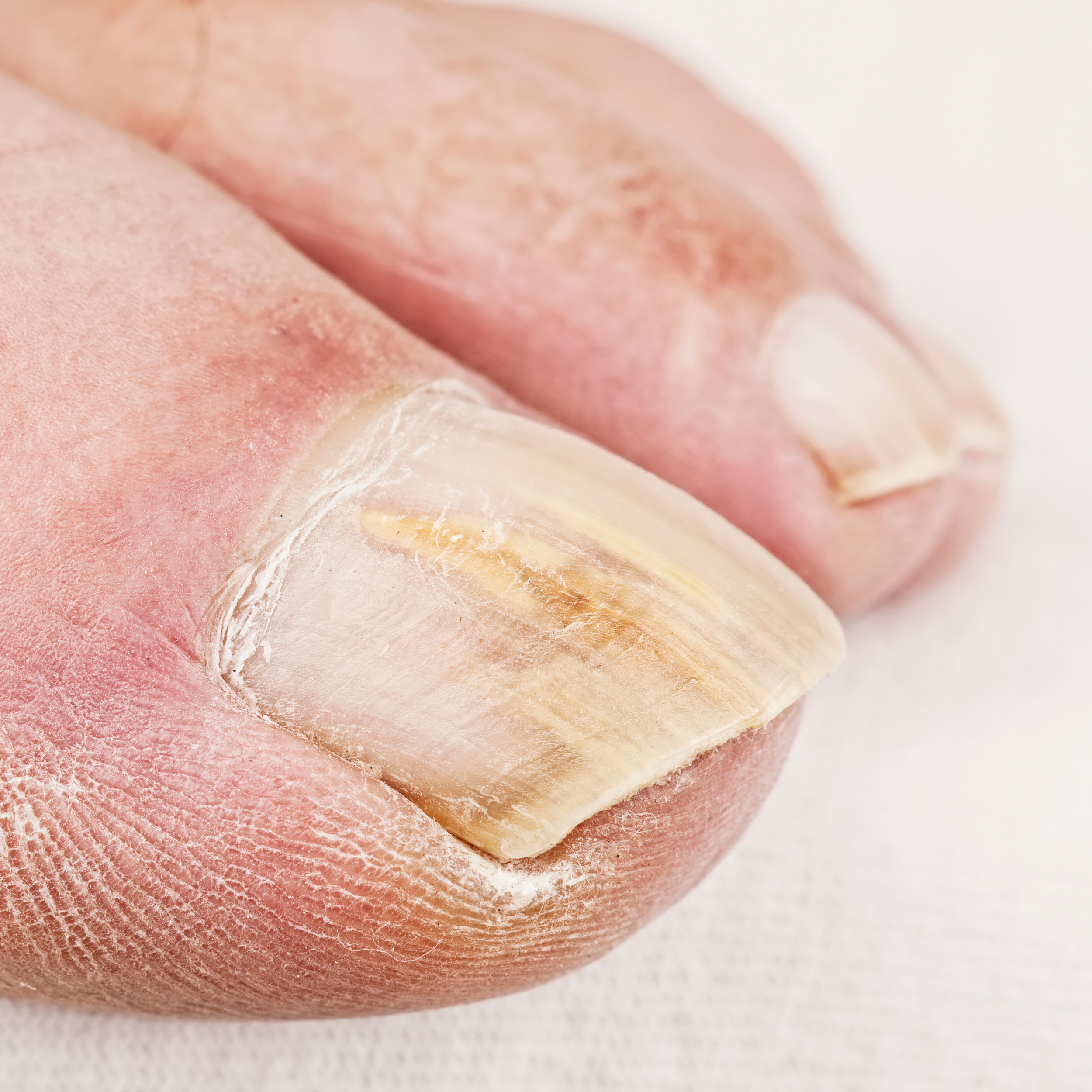 Early Stage Onychomadesis Presenting as Painful Swellings of Proximal Nail  Folds