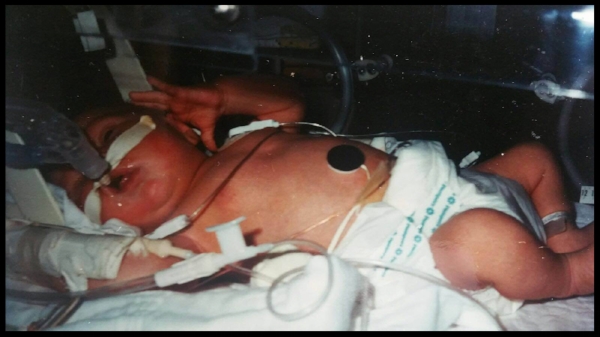 1984: Photo of me (Morgan Jamie Dunbar) on life support in the NICU after aspirating meconium in utero.