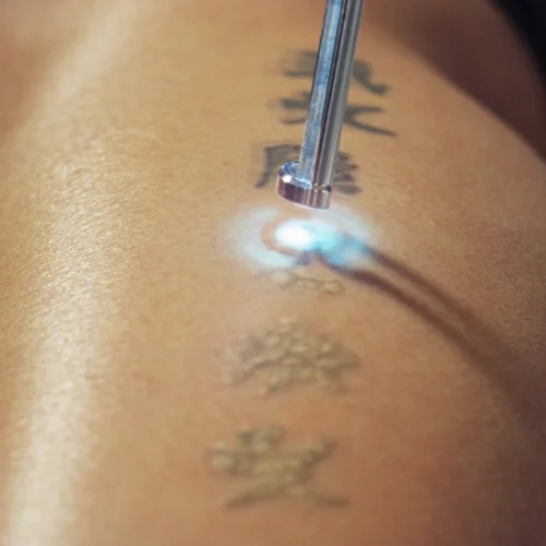 Tattoo-Removal-2-1024x682.jpg