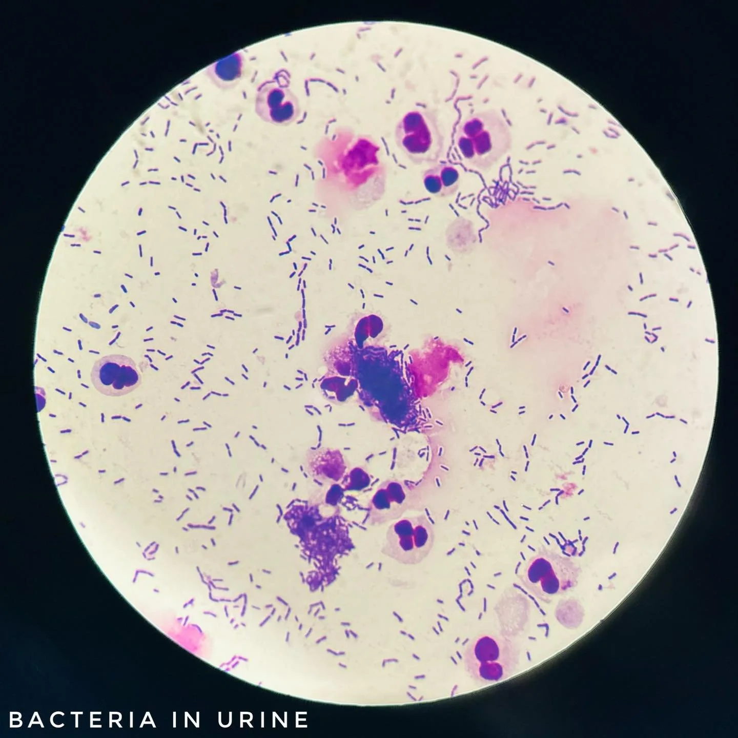 🔬 Microscopy Monday 🔬

This microscopic view of a urine sample shows large numbers of rod-shaped bacteria, confirming a urinary tract infection. You can also see neutrophils (a type of white blood cell) trying to fight the infection.

Our microscop