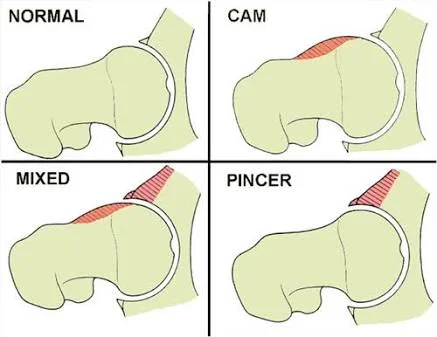 FEMOROACETABULAR IMPINGEMENT