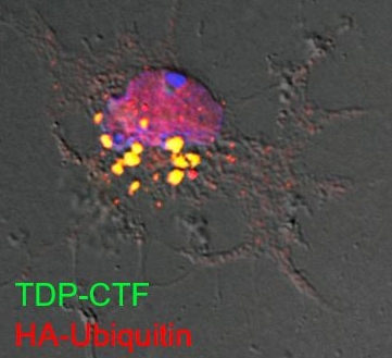 Primary motor neuron with ubiquitin-positive aggregates of the TDP-43 C-terminal fragment.