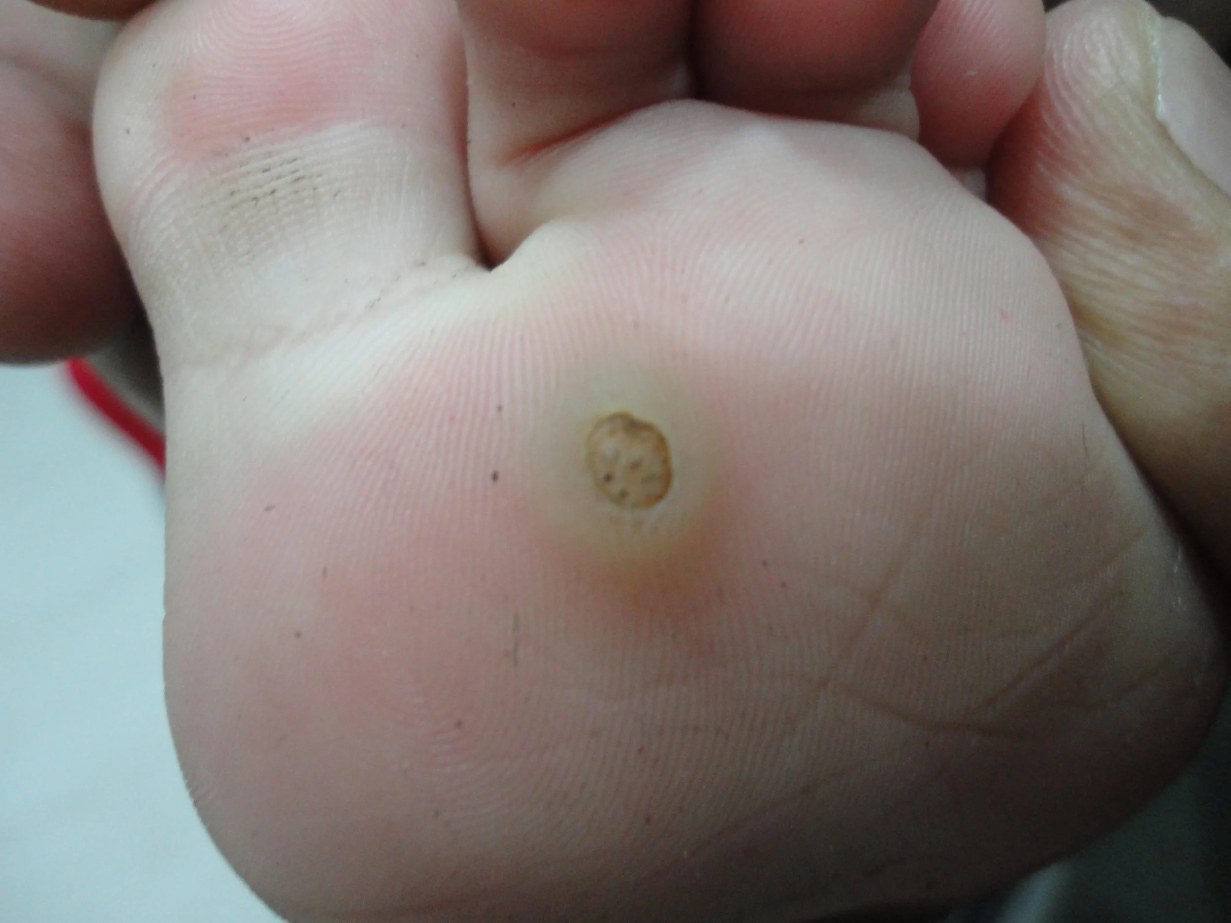 Warts Warts are one of several soft tissue conditions of the foot that can be quite painful. They are caused by a virus and can appear anywhere on the skin. Those that appear on the sole of the foot are called plantar warts. Children, especially teenagers, tend to be more susceptible to warts than adults. Some people seem to be immune to warts.