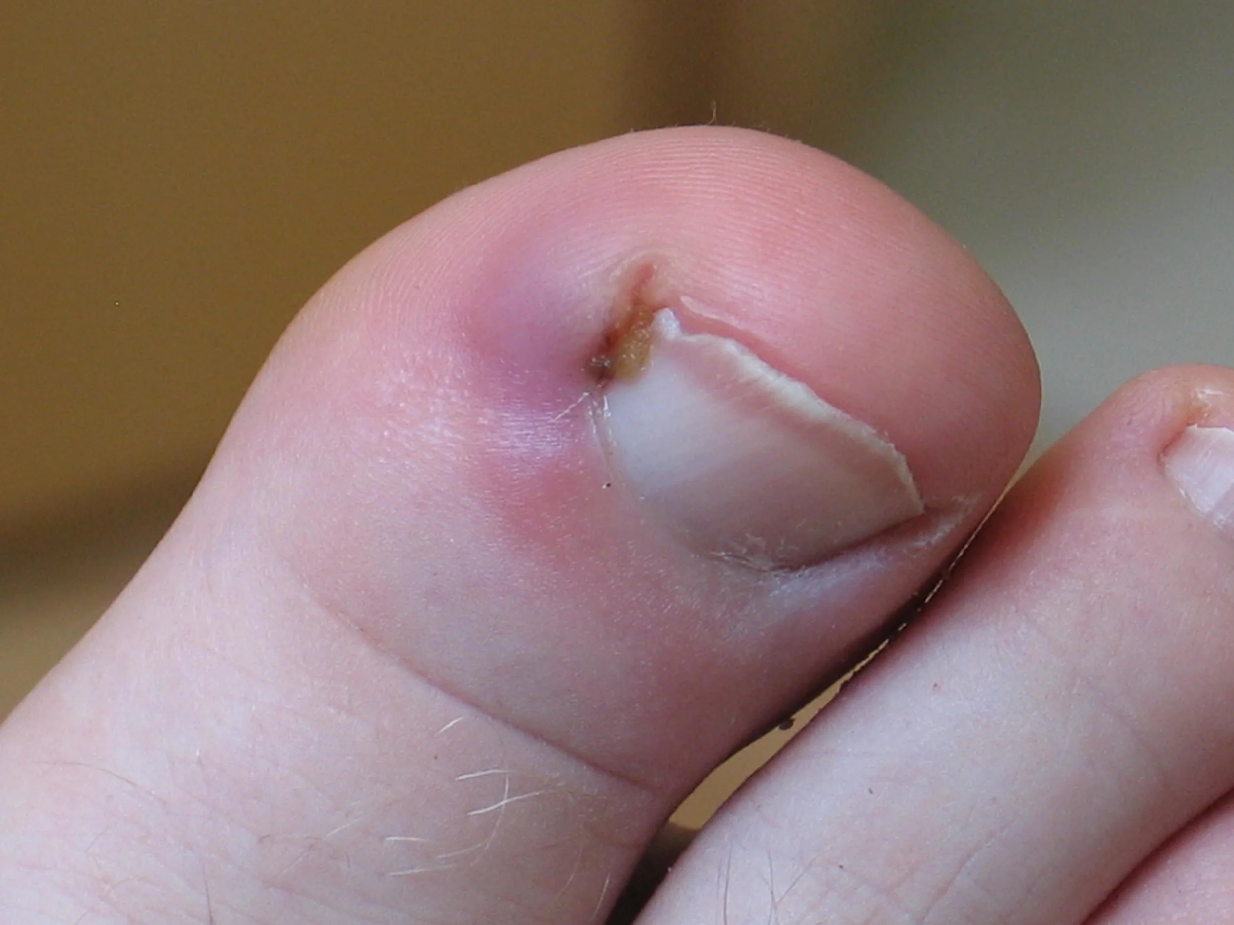 Ingrown Toenails Ingrown nails, the most common nail impairment, are nails whose corners or sides dig painfully into the soft tissue of nail grooves, often leading to irritation, redness, and swelling. Usually, toenails grow straight out. Sometimes, however, one or both corners or sides curve and grow into the flesh. The big toe is the most common location for this condition, but other toes can also become affected.