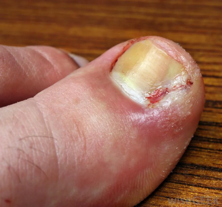 Toenail Fungus Toenail fungus, or onychomycosis, is an infection underneath the surface of the nail caused by fungi. When the tiny organisms take hold, the nail often becomes darker in color and smells foul. Debris may collect beneath the nail plate, white marks frequently appear on the nail plate, and the infection is capable of spreading to other toenails, the skin, or even the fingernails. If ignored, the infection can spread and possibly impair your ability to work or even walk. The resulting thicker nails are difficult to trim and make walking painful when wearing shoes. Onychomycosis can also be accompanied by a secondary bacterial or yeast infection in or about the nail plate.