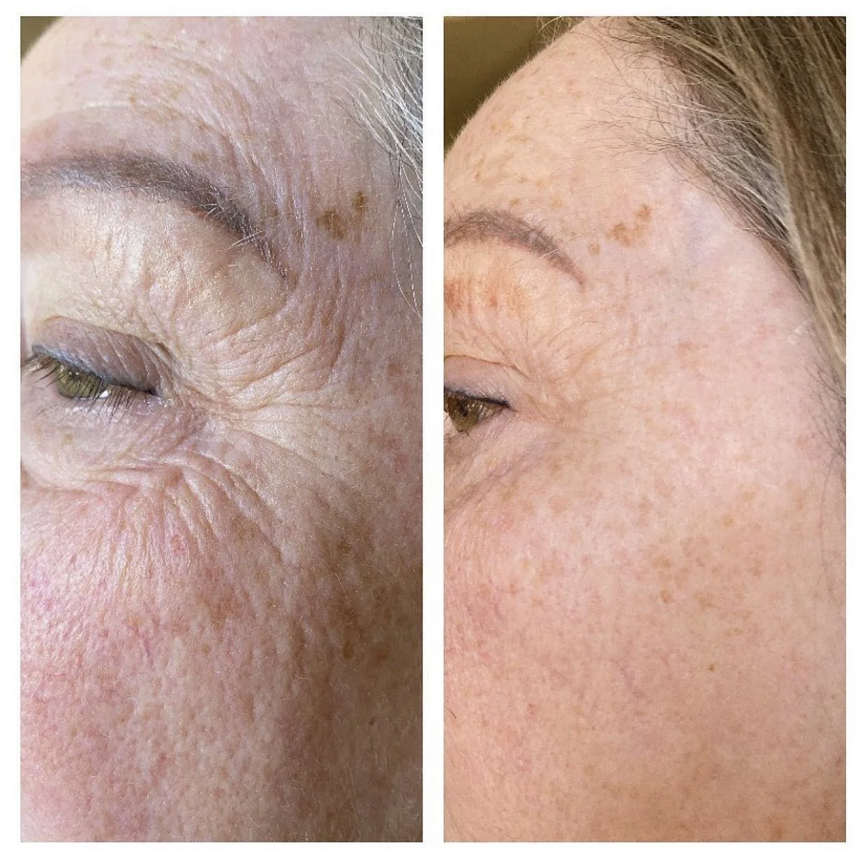 Jet Plasma Revitalization