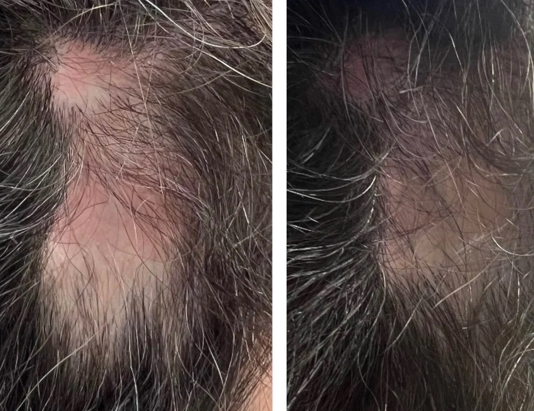 Jet Plasma Hair Restoration for Hair Loss