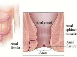 ANAL FISSURE : TEAR IN THE LINING OF THE ANUS