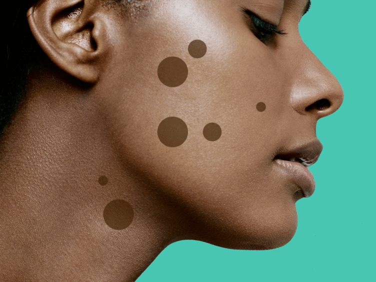 SELF: 8 Dark Spot Treatments That Really Work, According to Dermatologists