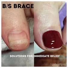bs bracing2.jpg