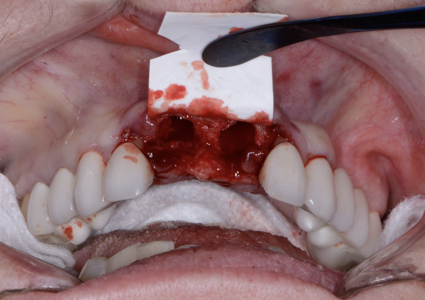AMP2 Plus: Info — Amplify Dental