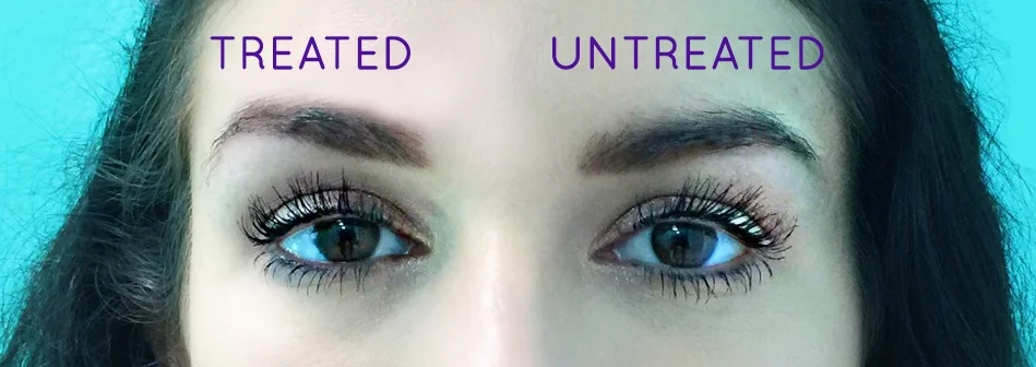 SkinTyte for Instant Brow Lift