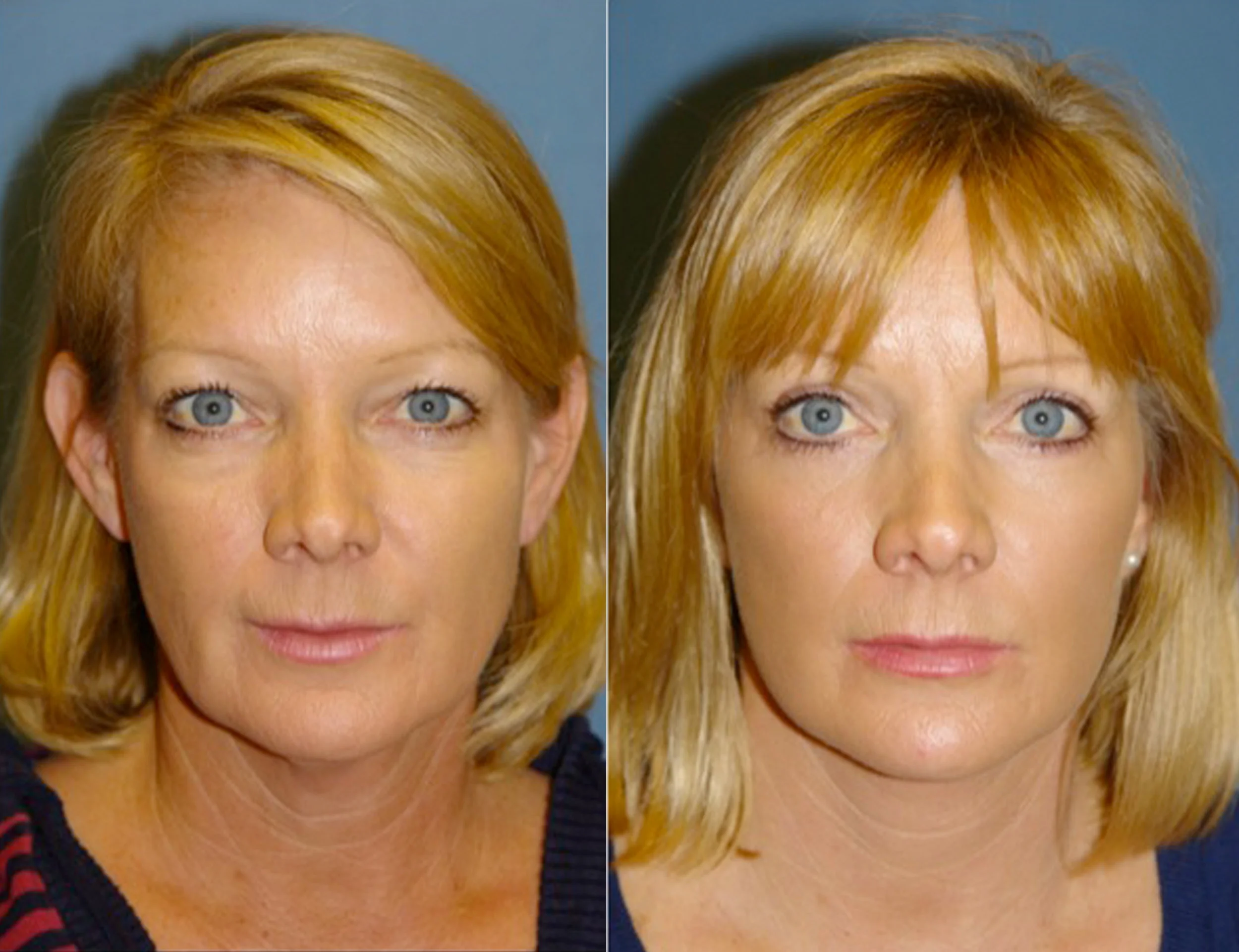 Blepharoplasty